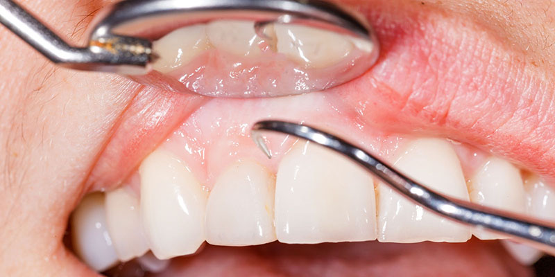 歯周病のよくある質問