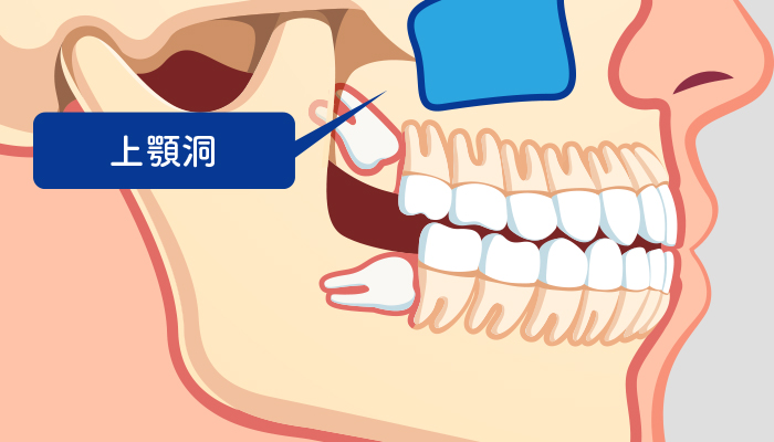 口腔外科で抜いたほうがいい歯はどんな歯？